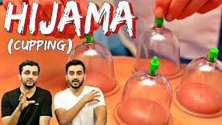 HIJAMA cupping  Why you should get it done l Hindi Urdu l The Baigan Vines [upl. by Copp956]