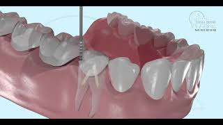 Endodontie und tiefe Hohlräume 3D Was es ist und wie es gemacht wird 3D [upl. by Eniale]