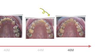 Class II Treatment with U1 Ankylosis｜【Chris Chang Ortho】CC755 [upl. by Ynaffyt]