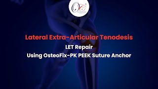 Lateral ExtraArticular Tenodesis LET Repair  OsteoFixPK PEEK Suture Anchor  Knee Arthroscopy [upl. by Nlycaj426]