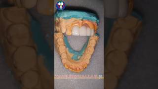 How to Make  PFM Glaze  Maxillary Insicor  Tooth Marbology  Art Work  trendingshorts dentist [upl. by Arim]