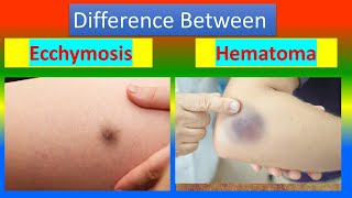 Difference between Ecchymosis and Hematoma [upl. by Naxela]