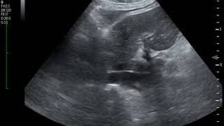 Thrombus in IVC Ultrasound JETem 2018 [upl. by Naggem]