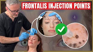 Injecting the Frontalis  Botox Injection Points amp Safety Advice [upl. by Ahsieni]