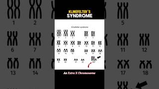 KLINEFELTER SYNDROME klinefeltersyndrome  WHAT IS KLINEFELTER SYNDROME shortsviraltrending [upl. by Huntley]