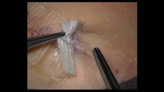 Removal of Steristrip Dried Tissue Glue and Anchoring Sutures [upl. by Bryner165]