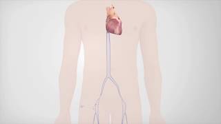 Radiofrequency Catheter Ablation [upl. by Goody]