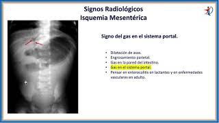 5 Isquemia Mesentérica [upl. by Nebeur160]