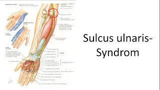 Sulcus ulnaris Syndrom [upl. by Kenlay]