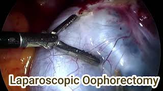 Laparoscopic Oophorectomy Both Side Ovaries  With In 10 Minutes  Step By Step  Day 83100 [upl. by Enifesoj325]