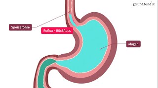 Was ist die Refluxkrankheit [upl. by Eilatam267]