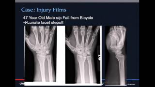 Comminuted intraarticular distal radius fractures  when to fix span or close reduce [upl. by Ninetta]