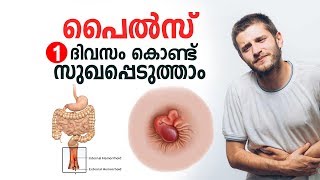 പൈൽസ് ഒരു ദിവസം കൊണ്ട് സുഖപ്പെടുത്താം  Piles Malayalam Health Tips [upl. by Tooley]