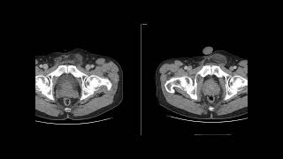 Scrotal Liposarcoma [upl. by Leuamme]