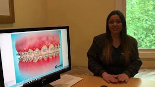 Decalcification of Teeth During Orthodontic Treatment [upl. by Loralee]