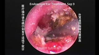 Embolization status of external auditory canal cholesteatoma [upl. by Vaughan]