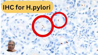 Unusual bacillary and coccoid forms of Helicobacter pylori [upl. by Amelita]