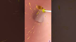 Ear wax removal 👂animation yourbody satisfying relaxing earwaxremoval hygiene [upl. by Eniortna215]