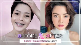 SUB Check out our Amazing Before and After FACIAL FEMINIZATION SURGERY FFS Top 5 [upl. by Utica]