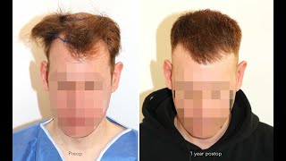 FUE Haartransplantation Haarlinie Mittelkopf amp Tonsur  4071 FUs [upl. by Silrak]