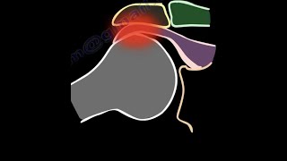 Shoulder Impingement Syndrome diagnosis and treatment shoulder pain shoulder bursitis cuff tears [upl. by Sigrid]