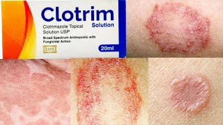 Clotrim Solution uses in Urdu Hindi  Clotrimazole  Fungal Infections [upl. by Setarcos]