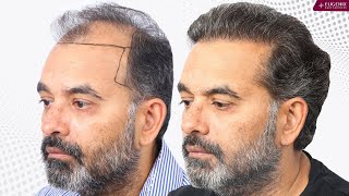 Best Hair Transplant Results from Day 1 to Month 10 [upl. by Llet]