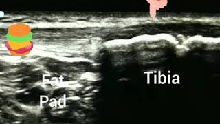 Osgood Schlatters Ultrasound [upl. by Clive]