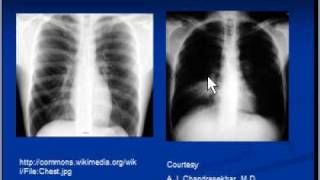 Chest xray interpretation  Lung consolidation and main causes [upl. by Ringo]