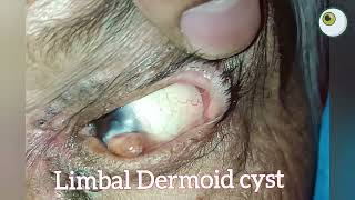 Limbal Dermoid cyst in eye  Tye of cyst in eye  Cyst or tumour on the limbus [upl. by Vaden391]