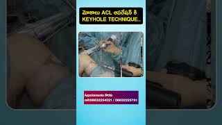 Knee pain amp instability  ACL tear surgery  New technique with keyhole Arthroscopy shorts acl [upl. by Andras502]