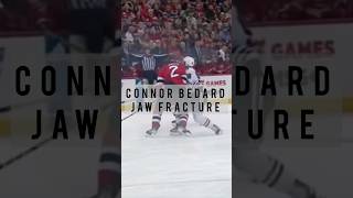 Connor Bedard Jaw Fracture [upl. by Jeri]