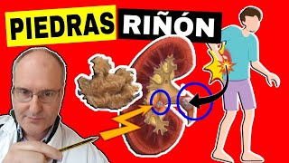 CÁLCULOS RENALES Síntomas Causas y Tratamiento de la LITIASIS RENAL Piedras en el Riñón [upl. by Daryle256]