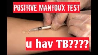 positive mantoux test tuberculin test positive result means [upl. by Isoais]