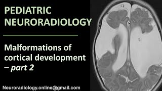 Pediatric Neuroradiology  Malformations of Cortical Development part 2 [upl. by Yenffit]