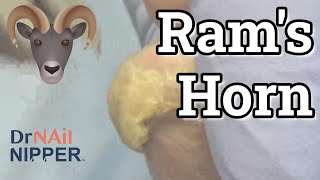 Best Rams Horn Toenails ALL YEAR How to cut rams horn toenails FEETure Friday 2022 [upl. by Oirram]