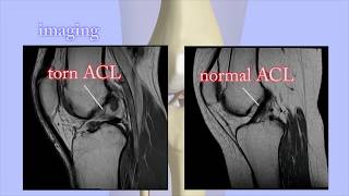 ACL Tears Diagnosis [upl. by Anaira717]