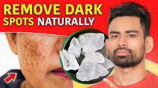 How to Remove Dark Spots and Get Clear Skin Pigmentation Dark Underarms Acne scars amp more [upl. by Mihar191]