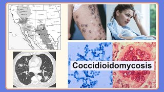 coccidioidomycosis [upl. by Asare]