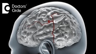 Can a ruptured Brain Aneurysm cause violent or aggressive behavior  Dr Tejus MN Rao [upl. by Lissak]