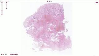 Choriocarcinoma  Histopathology [upl. by Yadahs]