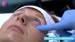 JETT PLASMA LIFT MEDICAL lower eyelids wrinkle smoothening [upl. by Wan878]