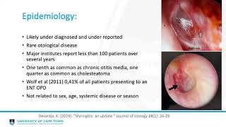 Granular myringitis Matthew White [upl. by Anomahs5]