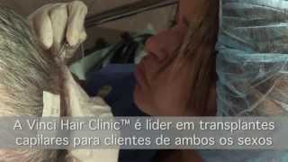 Transplante capilar Sao Paulo com Vinci Hair Clinic [upl. by Matta]