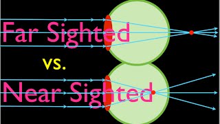 Farsighteness vs Nearsightedness An Explanation [upl. by Kato412]