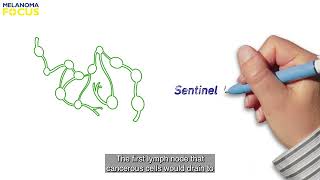 Understanding Sentinel Lymph Node Biopsy  1 of 2 [upl. by Horst]