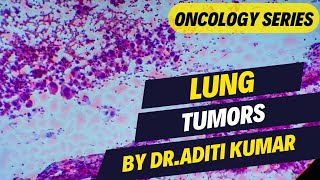 LUNG TUMORS  BY DR ADITI KUMAR [upl. by Eeresed]