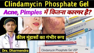 Clindamycin phosphate gel usp  clindamycin phosphate gel  clindac a gel how to use [upl. by Joycelin]