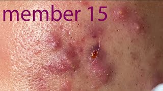 Acne Treatment Huong Da Nang membership 015   2023 [upl. by Mohandis82]