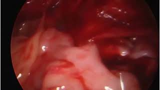 Laparoscopic Pyeloplasty in a 2 year old child [upl. by Ecneret565]